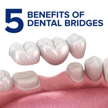 Savannah dentist Dr. Comer of Christopher Comer, DMD, explains the benefits of dental bridges, providing a reliable solution for missing teeth.